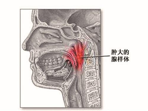 鼻甲肥大治疗需要多少钱