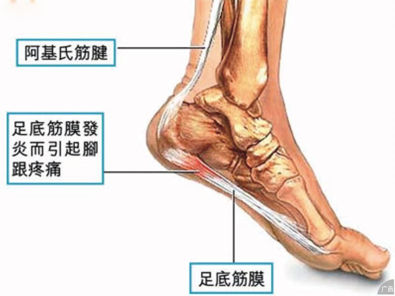 跟腱炎的治疗费用要多少