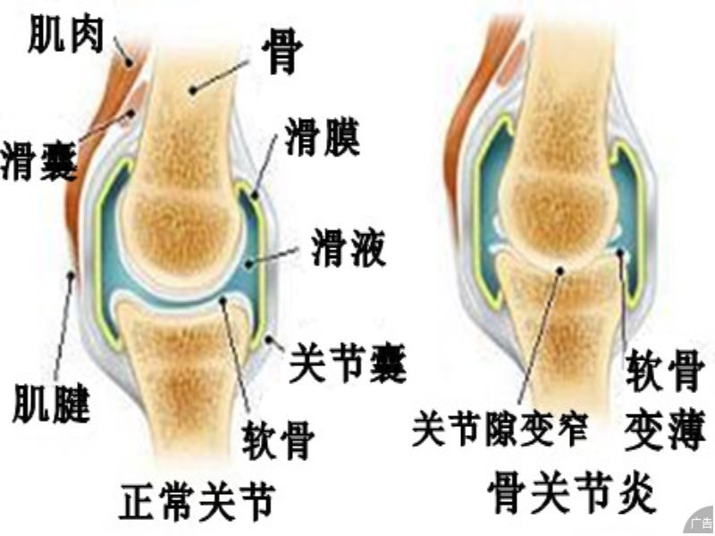 患上膝关节炎会引发什么症状