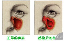 怎样知道自己得了鼻窦炎