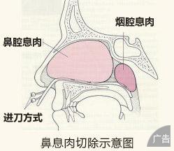 鼻息肉的症状具体有哪些呢