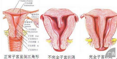 子宫纵膈有什么症状表现