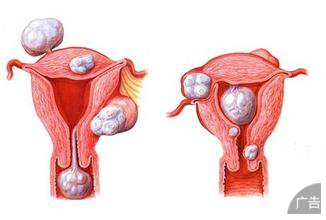 子宫肌瘤性不孕的症状有哪些