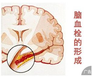 导致脑血栓发生的原因是什么