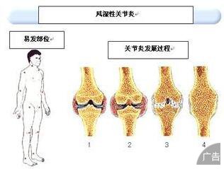 风湿性关节炎发病有哪些征兆