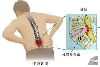 要怎么治腰椎肩盘突出