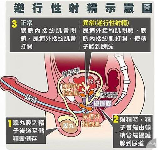 逆行射精的常见症状