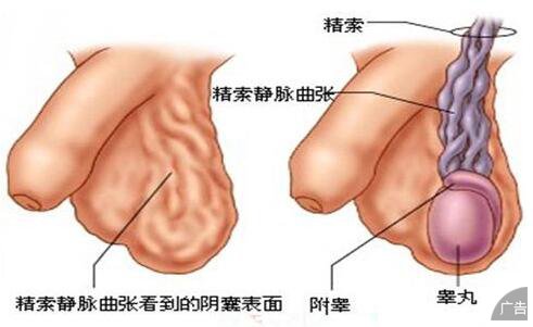 精索静脉曲张的症状表现具体是什么