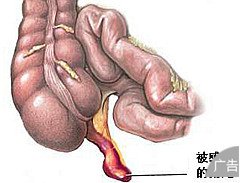 常见的阑尾炎的病因有哪些