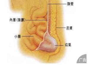 你知道疝气怎么治疗吗