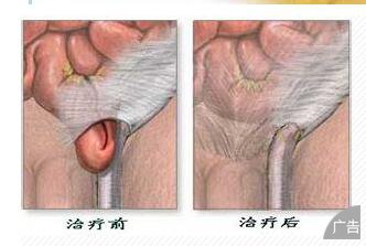 你知道小儿疝气的危害一般有哪些吗