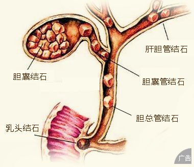 得了胆结石怎么办