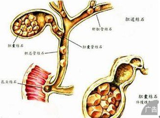 胆结石的治疗方法有哪些呢