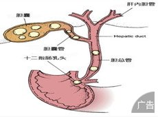 得了胆结石怎么治疗好