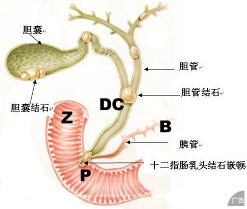 胆结石是怎样引起的