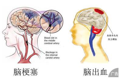 脑梗塞的危害大吗