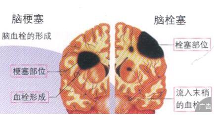 脑梗塞的危害究竟有哪些