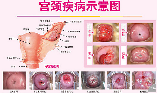 得了宫颈糜烂怎么办