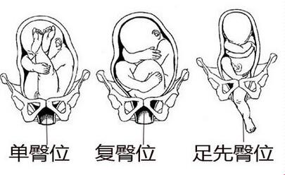 胎位不正能矫正过来吗