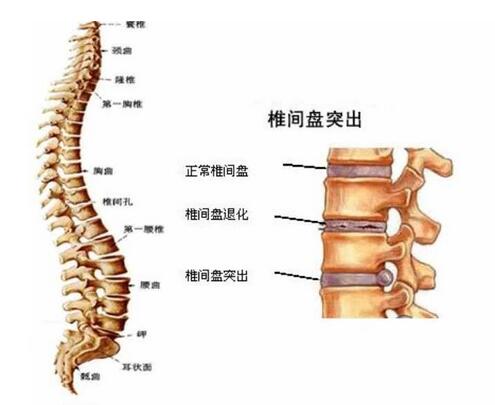 腰椎间盘突出的几大症状你了解吗