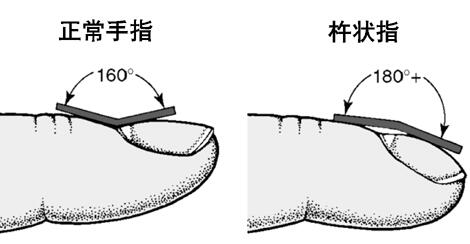 杵状指(趾)的症状是什么