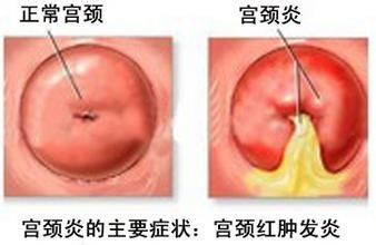 宫颈炎能够治好吗