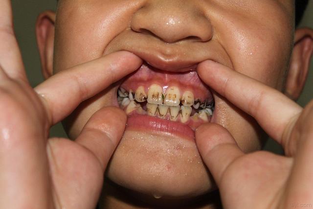牙龈上有黑斑是什么原因