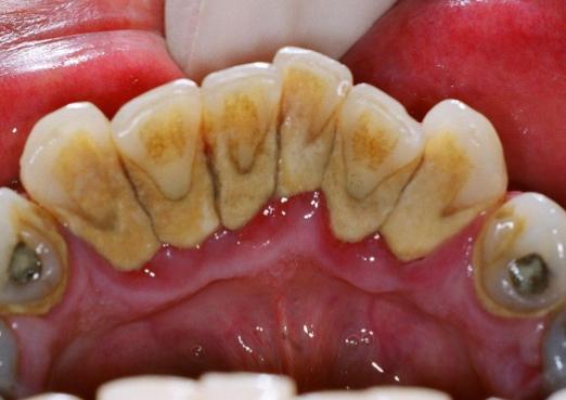 牙菌斑的治疗方法