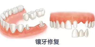 烤瓷牙修复的好处