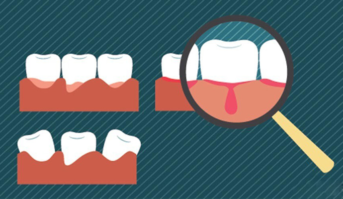 牙龈出血有哪些症状表现