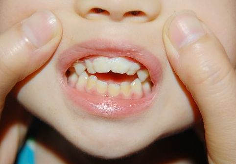 儿童矫正牙齿什么时间合适