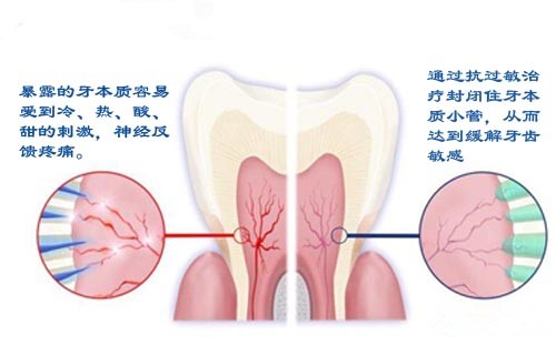 如何有效的预防牙髓炎