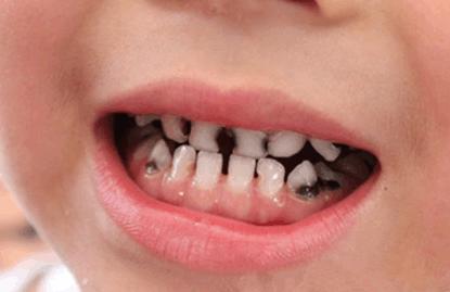 儿童牙列不齐有什么影响