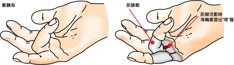 检查腱鞘炎的方法有哪些